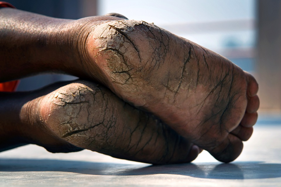 soften cracked heels
